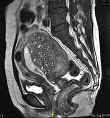 Sagittal MRI of a woman's pelvis showing a uterus with adenomyosis in the posterior wall. Gross enlargement of the posterior wall is noted, with many foci of hyperintensity. Adenomyosis MRI.jpg