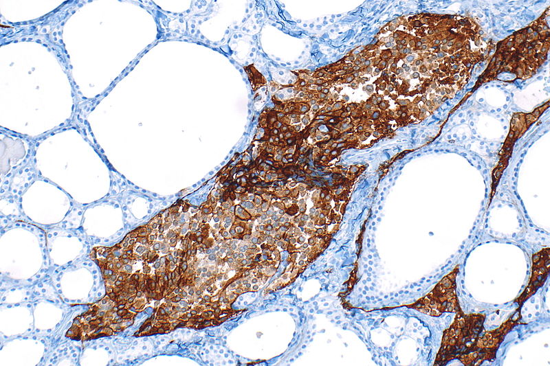 File:C-cell hyperplasia in MEN 2 - CEA -- intermed mag.jpg