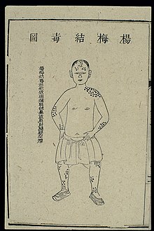Syphilitic sores depicted in Yuzuan yizong jinjian (China, 1742) Chinese C18 woodcut; External medicine - syphilitic sores Wellcome L0039895.jpg
