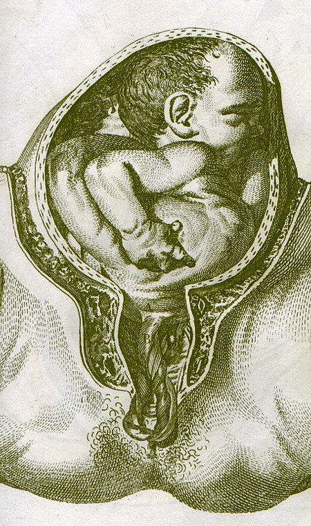 تدلي الحبل السري كما رسمه وليام سميلي عام 1792.