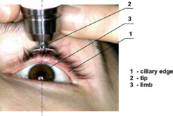 Diaton tonometer IOP through Eyelid.png