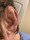 Thumbnail for Cauliflower ear