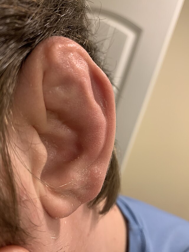 What Can Cause a Swollen Ear Lobe with pictures