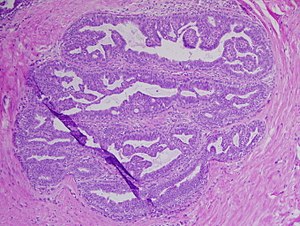 papilloma mean urdu cancer ovarian dupa histerectomie