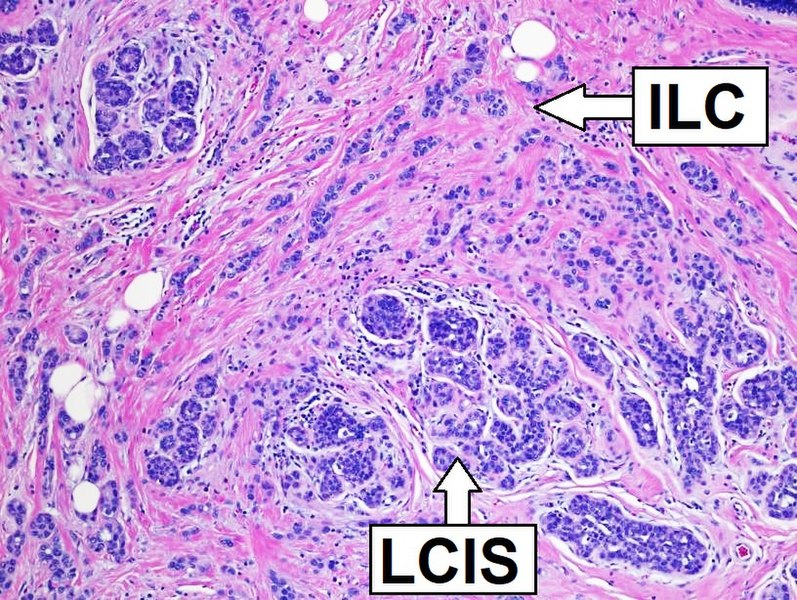 File:Histopathology of invasive lobular carcinoma, next to lobular carcinoma in situ, annotated.jpg