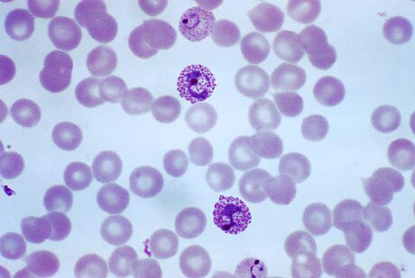 Plasmodium vivax