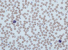 Iron deficiency anemia blood film.jpg