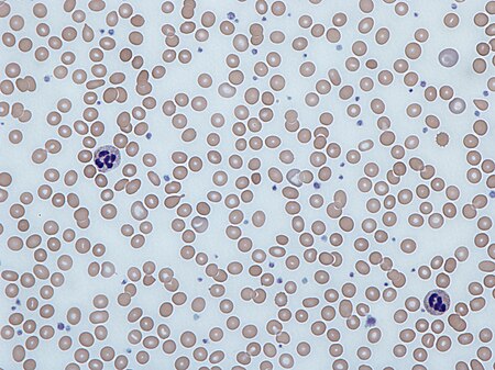 ไฟล์:Iron deficiency anemia blood film.jpg