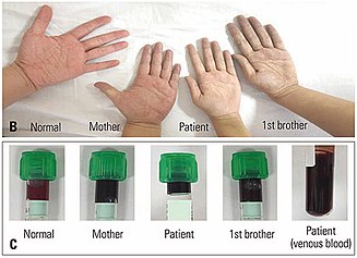 Differences in skin colors and arterial blood colors between a normal individual and patients Lifelong cyanosis and skin color and arterial blood color in the patient's family (cropped BC).jpg