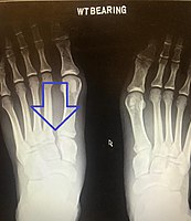 Lisfranc dislocation of the left foot due to lisfranc ligament rupture as seen on bilateral weight bearing radiographs.[1]