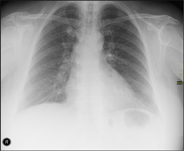 File:Medical X-Ray imaging AJD02 nevit.jpg