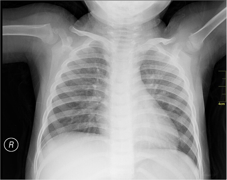 File:Medical X-Ray imaging BBV02 nevit.jpg