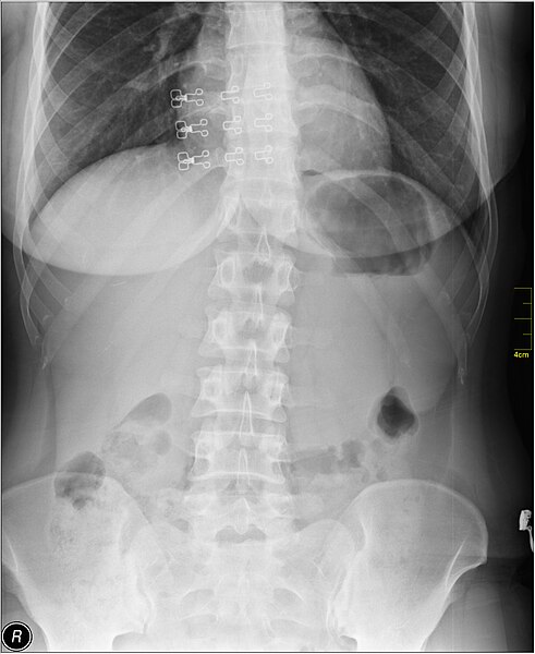 File:Medical X-Ray imaging QUZ06 nevit.jpg