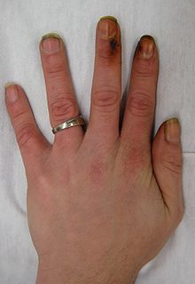 Tobacco stains on primarily the second and third fingers of a heavy smoker Nicotine stains10.JPG