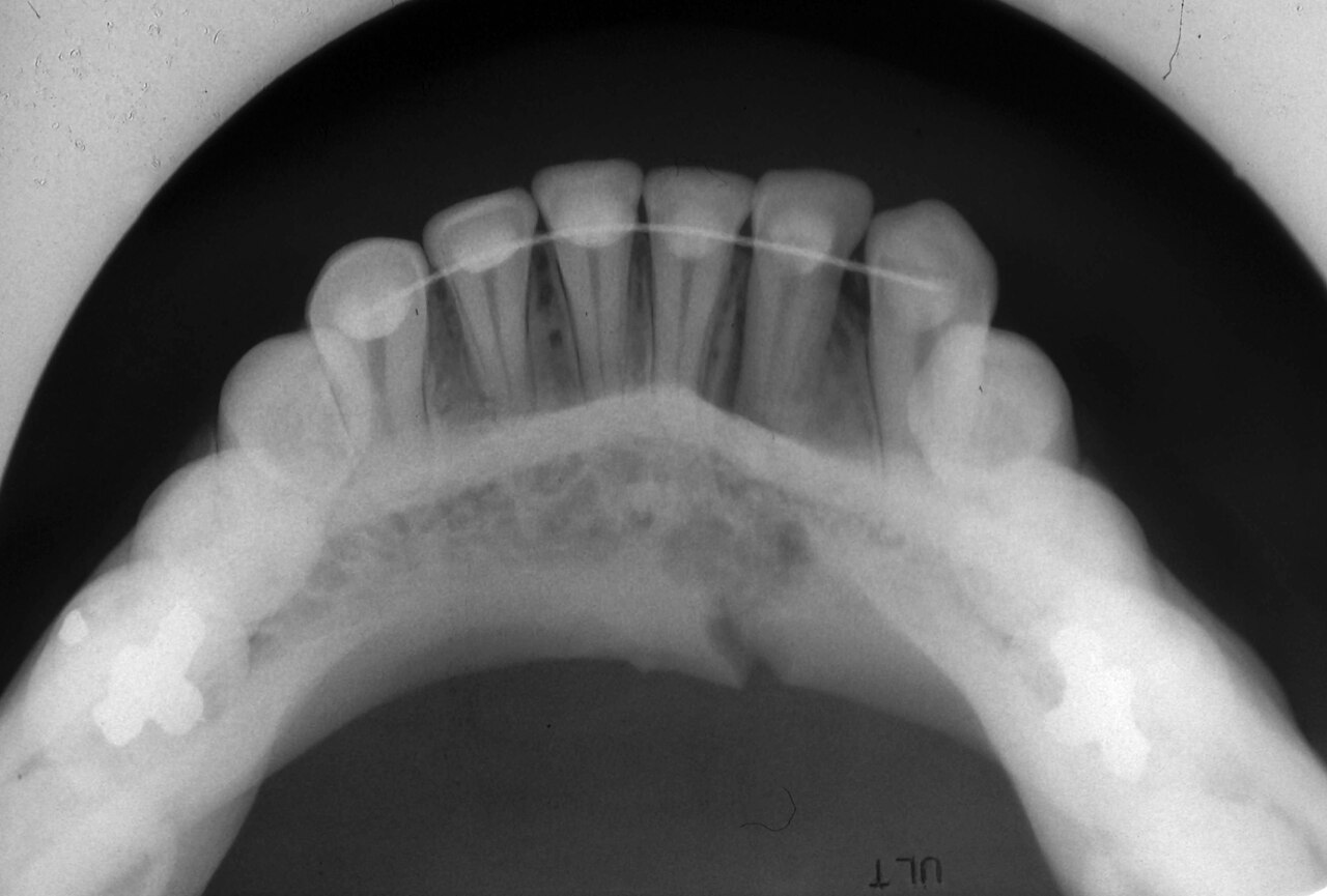 Occlusal view symphsis fracture.jpg