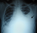 Հնդիկ տղամարդու մոտ զանգվածային թոքամզային արտաքիրտի հայտնաբերում կրծքավանդակի ռենտգեն պատկերով։ Հետագայում նրա մոտ հաստատվեց հեմոթորաքս։