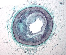 Micrograph of a coronary artery with the most common form of coronary artery disease (atherosclerosis) and marked luminal narrowing. Masson's trichrome. RCA atherosclerosis.jpg