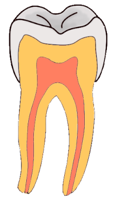Imej animasi menunjukkan perkembangan bentuk lesi karies di rantau serviks gigi.