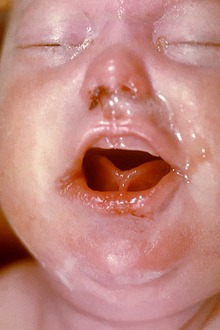 The face of a newborn infant displaying snuffles indicative of congenital syphilis The face of a newborn infant with Congenital Syphilis.tif