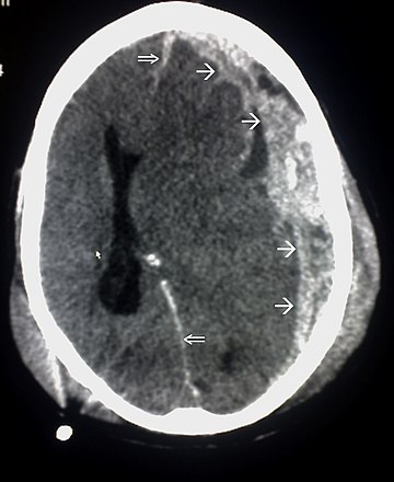 Schädel-Hirn-Trauma