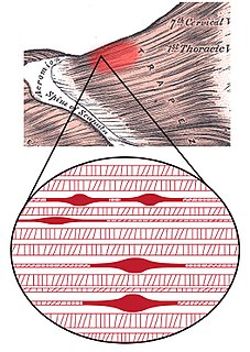 Myofascial trigger point Medical condition