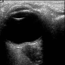 Figure 5: On-orbit ultrasound of posterior orbit of the fourth case of visual changes from long-duration spaceflight. In-flight ultrasound image of the right eye showing posterior globe flattening and a raised optic disc consistent with optic-disc edema and raised ICP. VIIP Figure 5.png