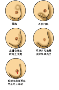 Zh Breast cancer illustrations.GIF