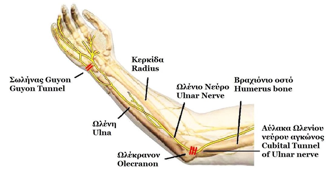 Ulnar neuropathy at the elbow