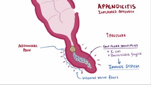 Appendicitis.webm