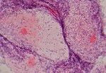 Miniatuur voor Bestand:Clue cell in bacterial vaginosis.jpg