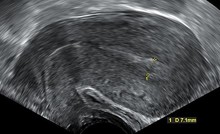 Transvaginal ultrasonography after an episode of heavy bleeding in an intrauterine pregnancy that had been confirmed by previous ultrasonography. There is some widening between the uterine walls, but no sign of any gestational sac, thus, in this case, being diagnostic of a complete miscarriage.