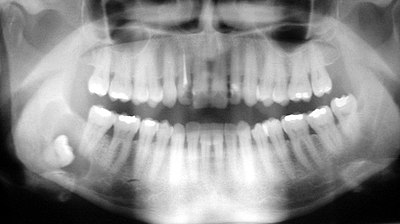 Cyst - wisdom tooth.jpg