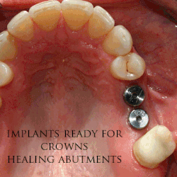 Dental-implant.gif