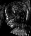Ecografia del cap (de perfil) d'un fetus de 14 setmanes