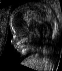 Obstetric ultrasonography showing a fetus at 14 weeks of gestational age, through the median plane. Embryo at 14 weeks profile.JPG