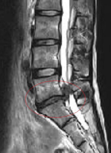 File:HerniatedSpinalDisk-NarrowedNerveRoot.JPG