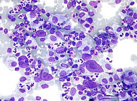 Hodgkin lymphoma cytology large.jpg