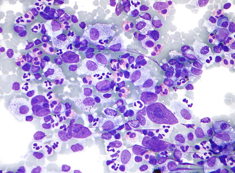 Hodgkin lymphoma pic