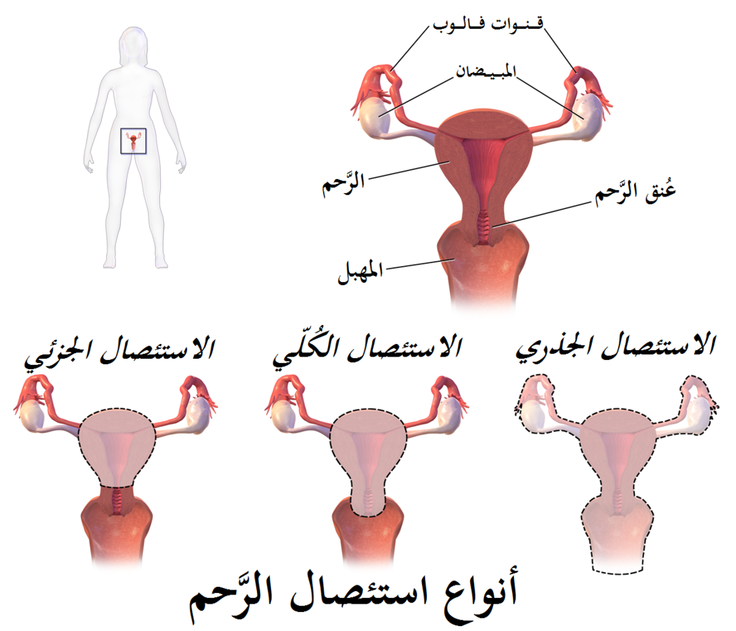 ملف:Hysterectomy-ar.png.