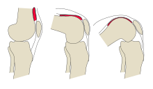 Unfolding suprapatellar recess. Knee-unfolding-recess-diagram.svg