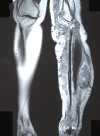 <span class="mw-page-title-main">Peripheral nerve tumor</span> Medical condition