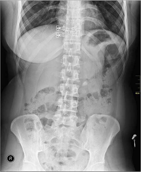 File:Medical X-Ray imaging PLZ06 nevit.jpg