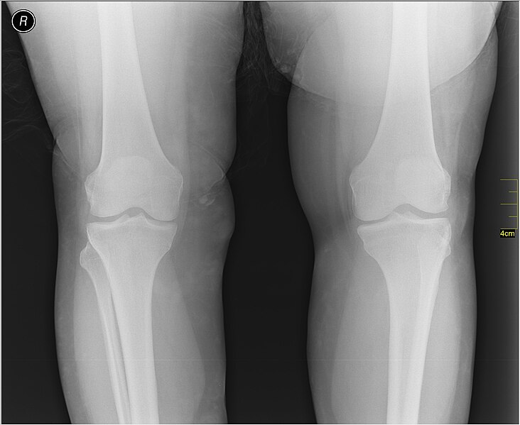 File:Medical X-Ray imaging RCV06 nevit.jpg