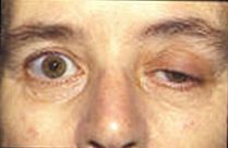 Patient with myasthenia gravis showing typical symptom of eyelid droop Myasthenia.jpg