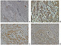 Neuropilin-2 expression in normal breast and breast carcinoma tissue.