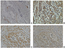 Neuropilin 2 expression in (A) blood vessels, (B) carcinoma tissue, (C and D) breast carcinoma tissue with co-localized staining for neuropilin 2 and CXCR4, a chemokine receptor. Neuropilin 2 is a known marker for venous blood vessels, indicating the vascularization of the tumour. Neuropilin-2 (Nrp2) expression in normal breast and breast carcinoma tissue.jpg