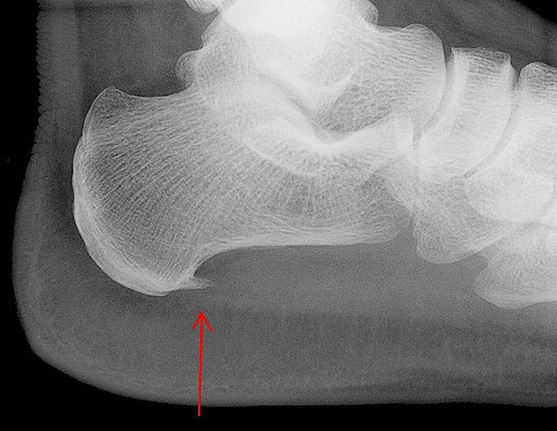 a heel spur can cause heel pain running