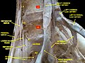 Lumbar and sacral plexus. Deep dissection. Anterior view.