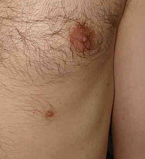 Supernumerary nipple