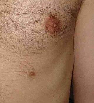 <span class="mw-page-title-main">Supernumerary nipple</span> Medical condition